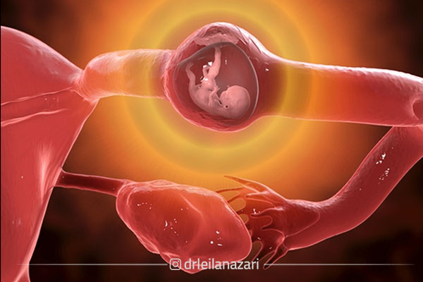 علائم بارداری خارج از رحم