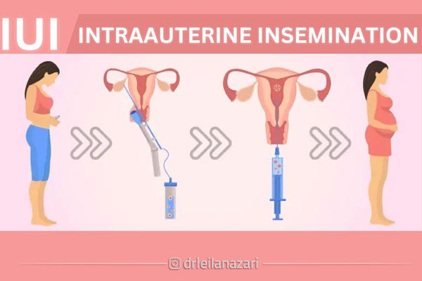 iui برای چه کسانی جواب می‌ دهد