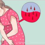 چه خونریزی در بارداری خطرناک است و چه خونریزی در بارداری طبیعی است؟