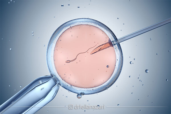 IVF