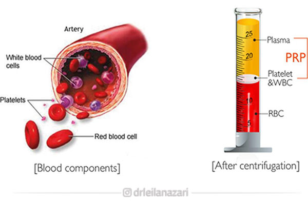 آیا تزریق PRP خطر یا عوارضی دارد؟