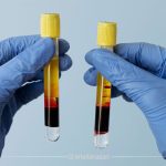 ترکیب PRP و سلول های بنیادی؛ تحولی نوین در درمان ناباروری زنان؟
