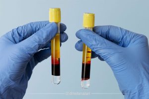 ترکیب PRP و سلول های بنیادی