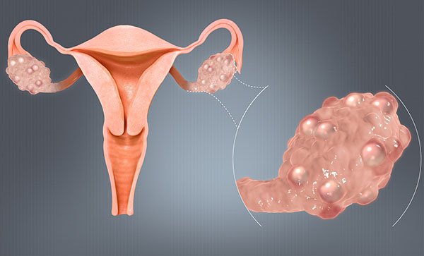 داروهای ضدافسردگی و سندرم تخمدان پلی کیستیک (PCOS)