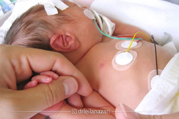 وقوع بارداری زودهنگام (Preterm)