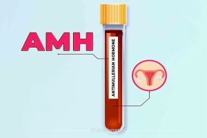بررسی دقیق AMH و اهمیت آن در سنجش باروری