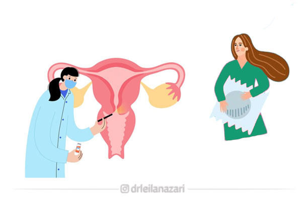 چه کسانی به Sono-HSG نیاز دارند؟ شناسایی کاندیداهای مناسب