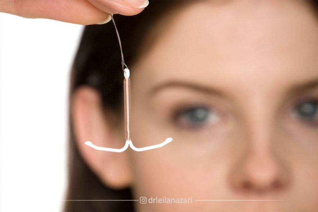 آی یو دی (IUD) چیست؟ معرفی انواع مسی و هورمونی